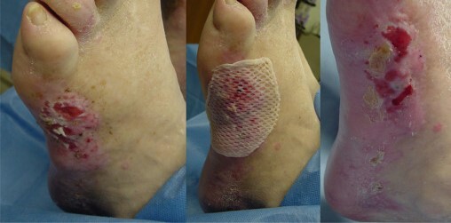 skin graft ulcer